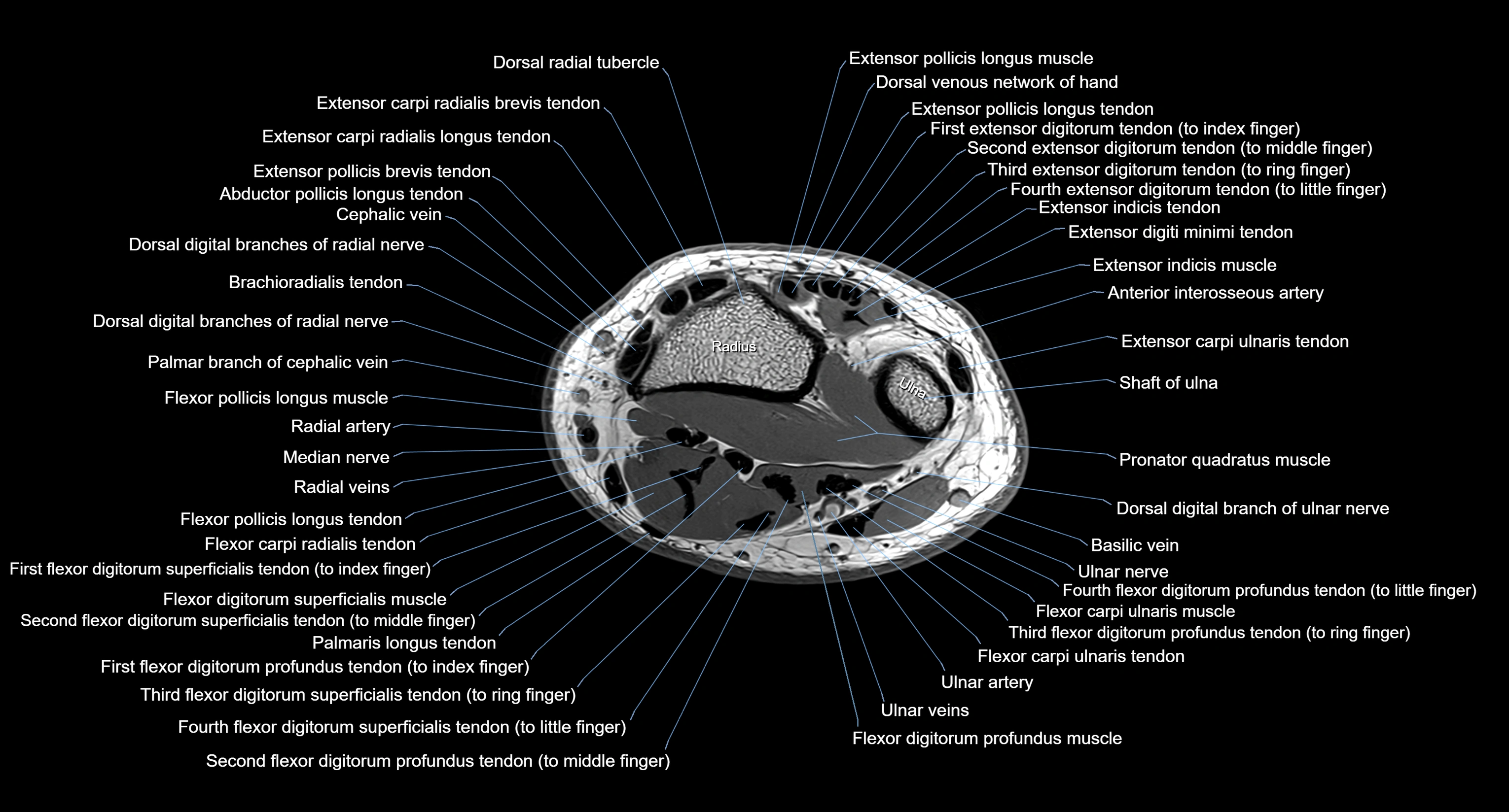 MRI wrist axial cross sectional anatomy 3T radiology  image-img-00001-00032.webp